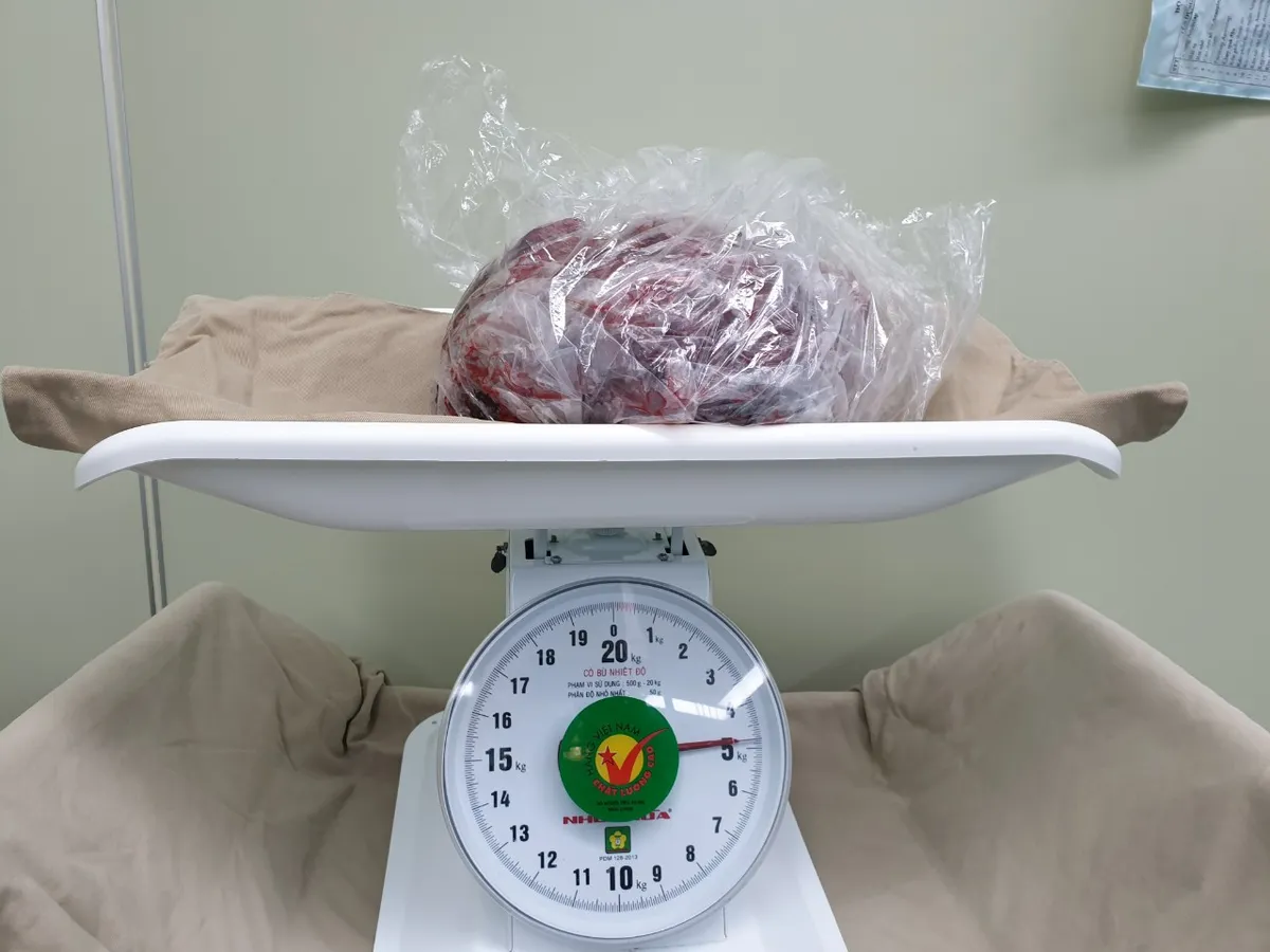 GIST dạ d&agrave;y - Căn bệnh l&agrave;nh t&iacute;nh để muộn th&agrave;nh ung thư - Ảnh 1.