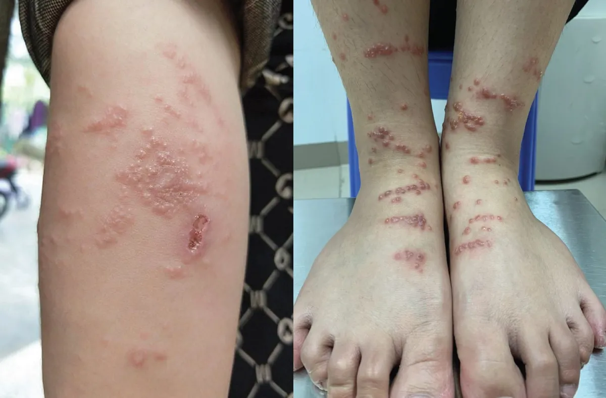 Bé trai bị loét da sau khi tiếp xúc với sứa biển - Ảnh 1.