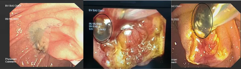 Nhiễm trùng đường mật do sán lá gan - Ảnh 1.