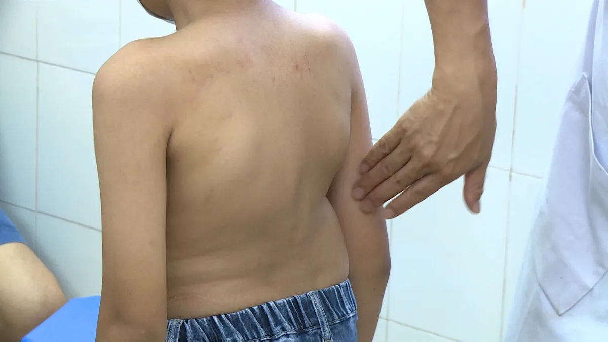 Cẩn trọng: Trẻ bị gù vẹo cột sống không được phát hiện kịp thời - Ảnh 2. Cẩn trọng: Trẻ bị gù vẹo cột sống không được phát hiện kịp thời - Ảnh 2.