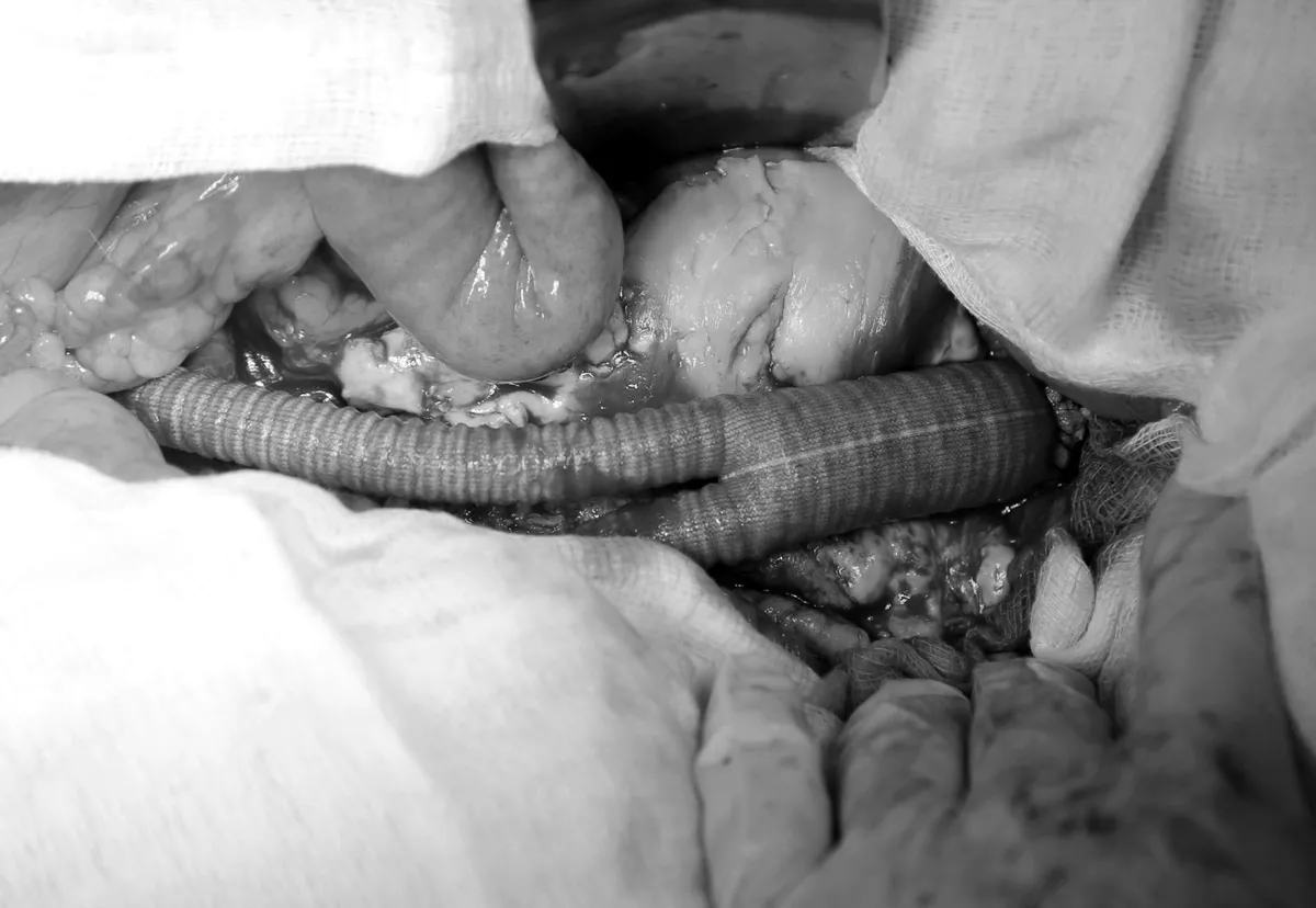 Cảnh giác với căn bệnh nguy hiểm: Phình động mạch chủ bụng - Ảnh 1.