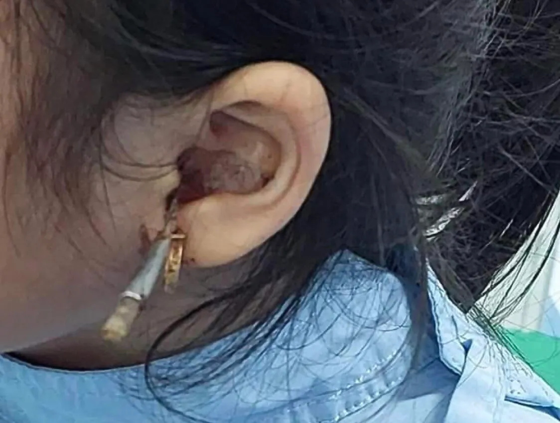 Lấy ráy tai, bé gái bị que kim loại xuyên qua màng nhĩ - Ảnh 1.