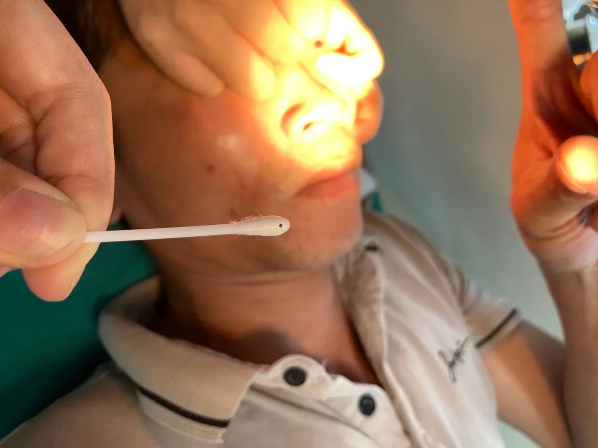 Gắp mảnh vụn sắt găm vào giác mạc bệnh nhân - Ảnh 1.