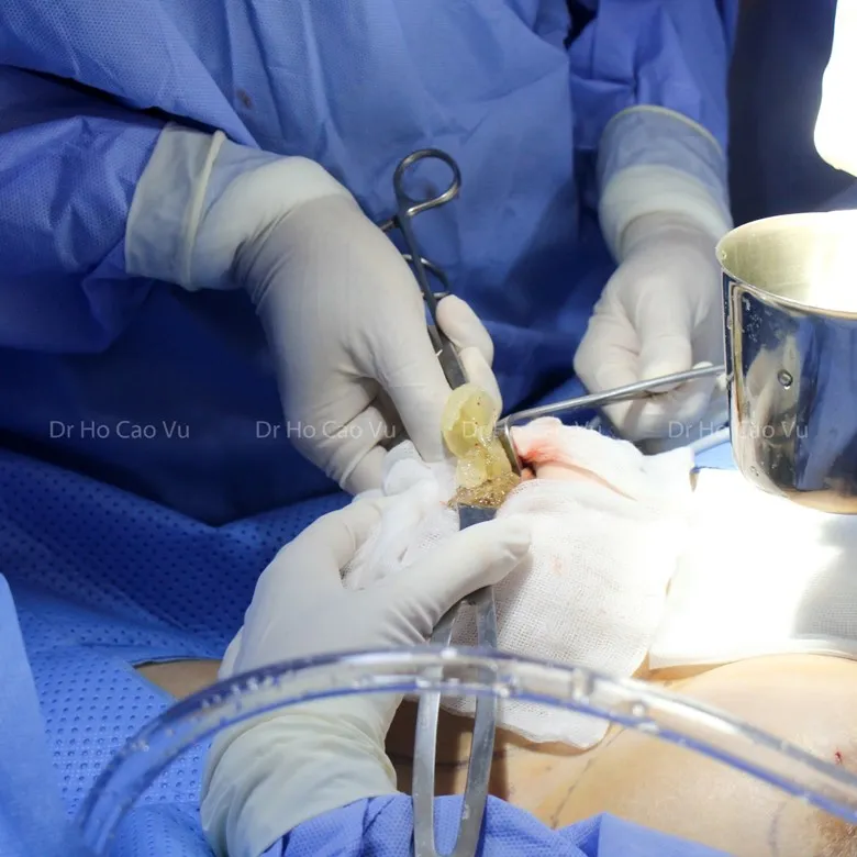 Khuyến khích tháo túi ngực nhám tránh bệnh lý nguy hiểm - Ảnh 1.