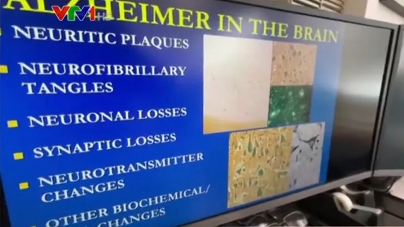 Thuốc mới điều trị bệnh Alzheimer - Ảnh 1.