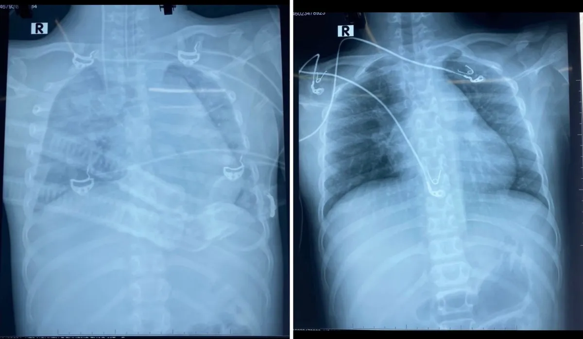 Chạy ECMO cứu sống bé gái 11 tuổi bị đa chấn thương nguy kịch - Ảnh 1. Chạy ECMO cứu sống bé gái 11 tuổi bị đa chấn thương nguy kịch - Ảnh 1.
