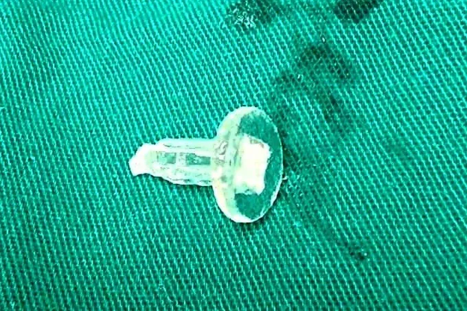 Nam sinh 11 tuổi khó thở nặng, nguy kịch vì thói quen ngậm bút bi - Ảnh 2. Nam sinh 11 tuổi khó thở nặng, nguy kịch vì thói quen ngậm bút bi - Ảnh 2.