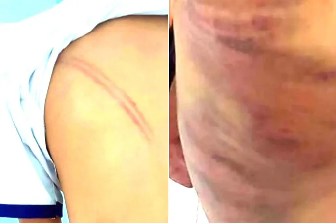 Khởi tố mẹ kế đ&aacute;nh con chồng ở C&agrave; Mau - Ảnh 1.