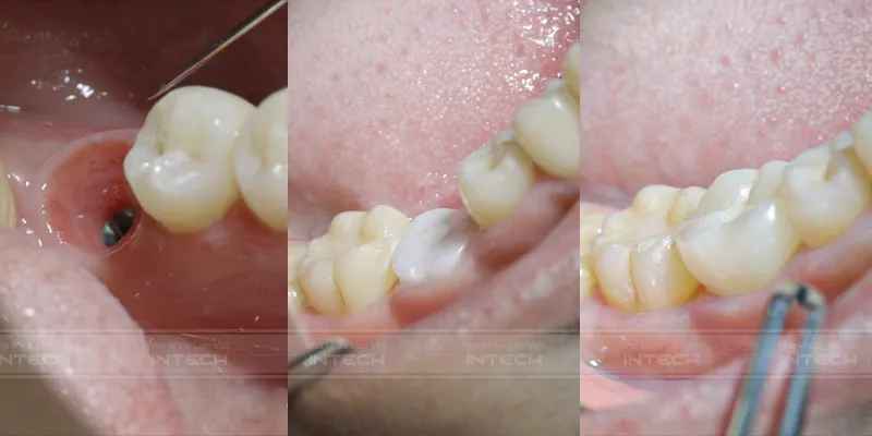 Sai lầm phổ biến khi trồng răng implant - Ảnh 4. Sai lầm phổ biến khi trồng răng implant - Ảnh 4.