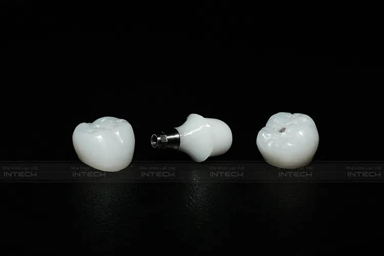 Sai lầm phổ biến khi trồng răng implant - Ảnh 1. Sai lầm phổ biến khi trồng răng implant - Ảnh 1.