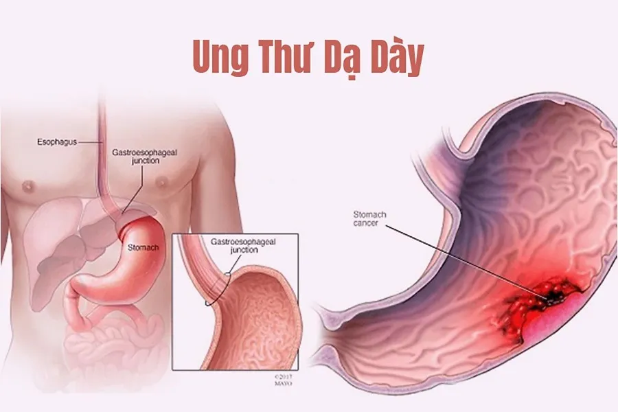 ung-thu-da-day-song-duoc-bao-lau1-163011815907774515423-1682303782 ung-thu-da-day-song-duoc-bao-lau1-163011815907774515423-1682303782