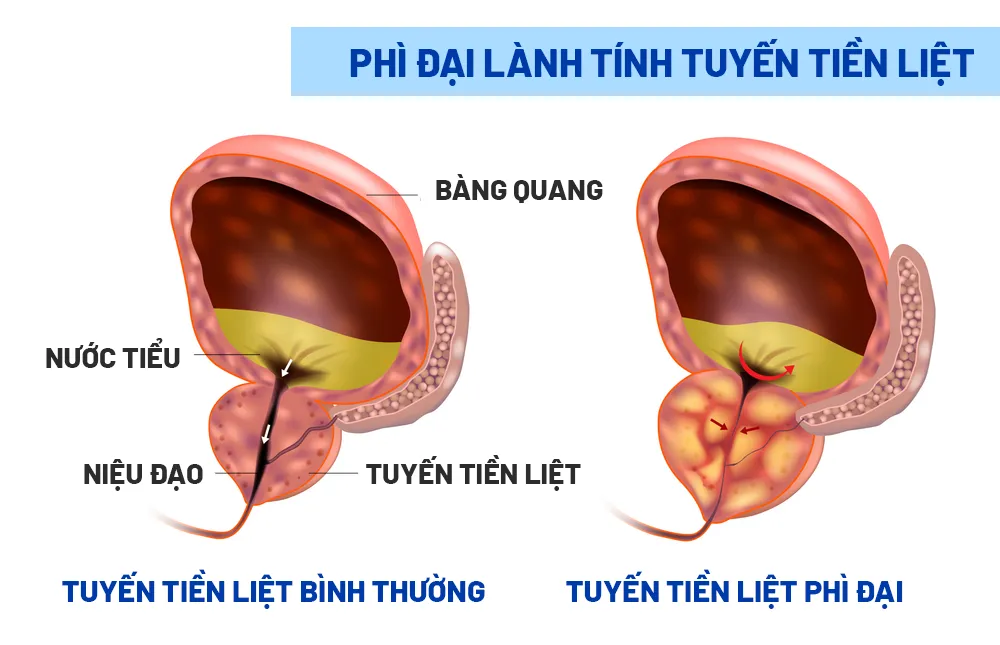 Điều trị phì đại tuyến tiền liệt lành tính không phẫu thuật - Ảnh 4.