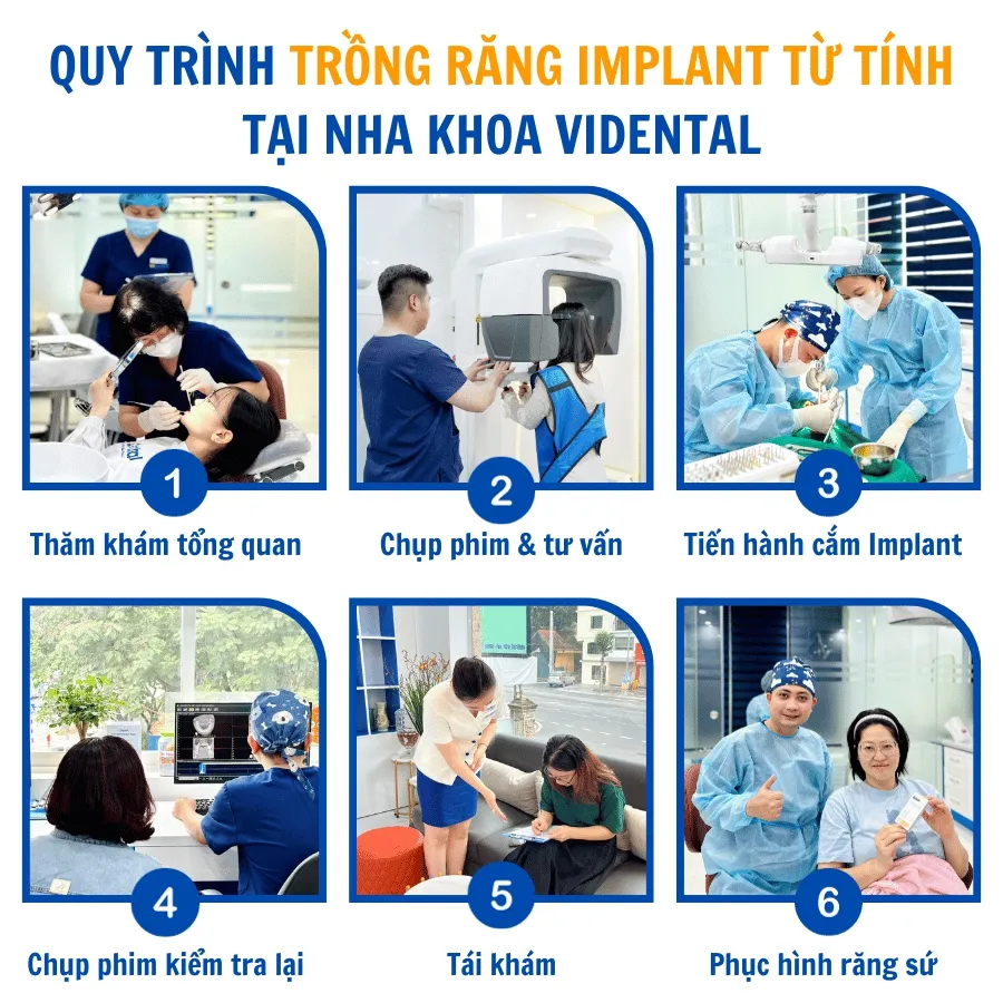 Nha khoa ViDental trồng răng bằng công nghệ từ tính, không khoan xương - Ảnh 4. Nha khoa ViDental trồng răng bằng công nghệ từ tính, không khoan xương - Ảnh 4.