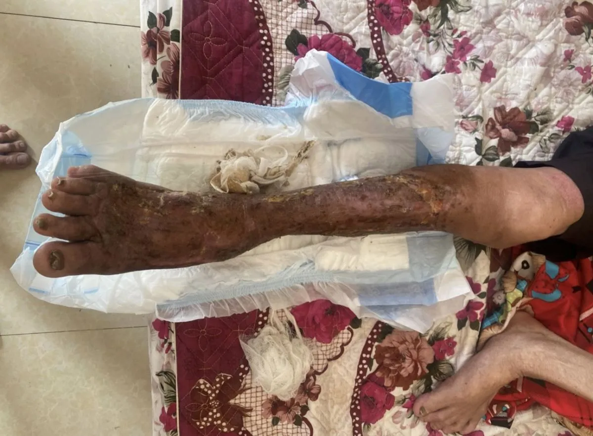 Sốc nhiễm trùng, hoại tử da bàn chân do nhiễm vi khuẩn ăn thịt người - Ảnh 1. Sốc nhiễm trùng, hoại tử da bàn chân do nhiễm vi khuẩn ăn thịt người - Ảnh 1.