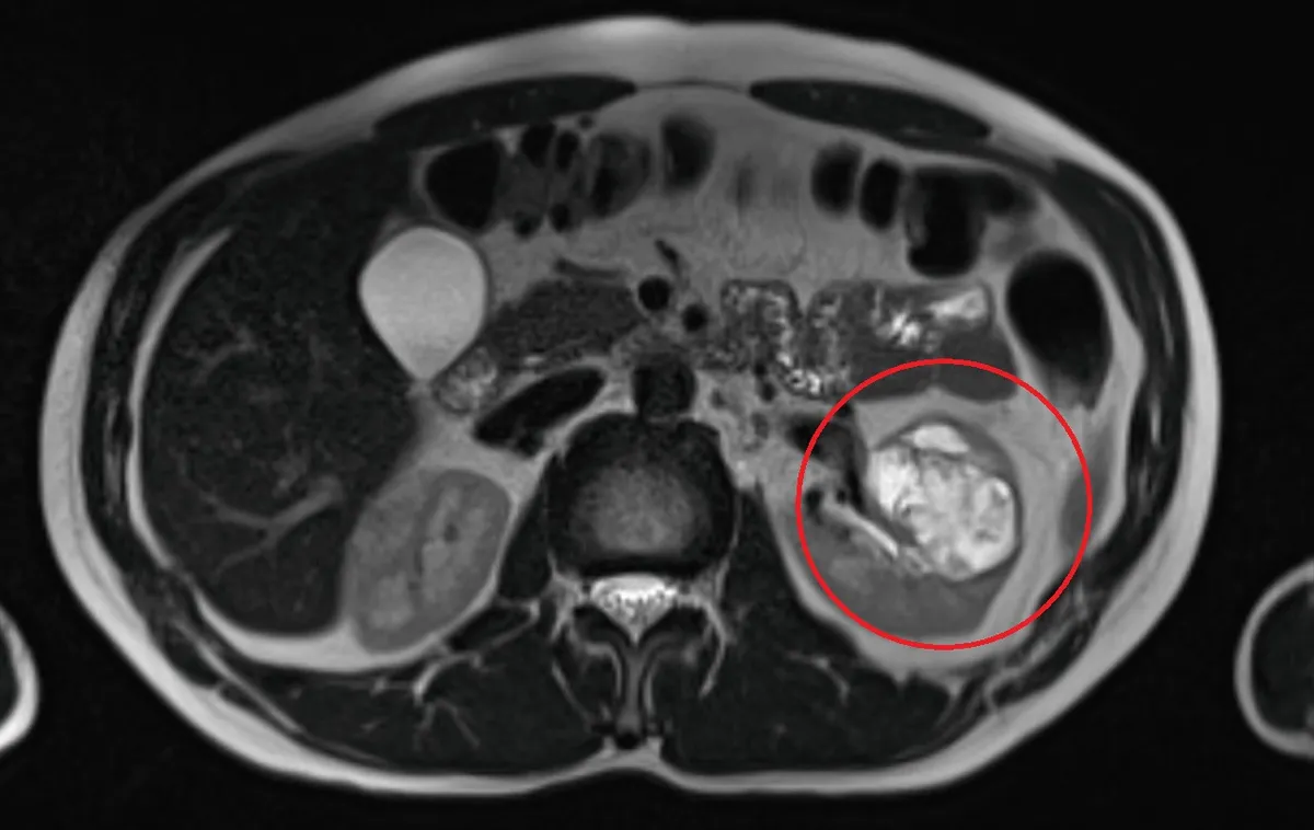 95% bướu thận là ác tính - Ảnh 1.
