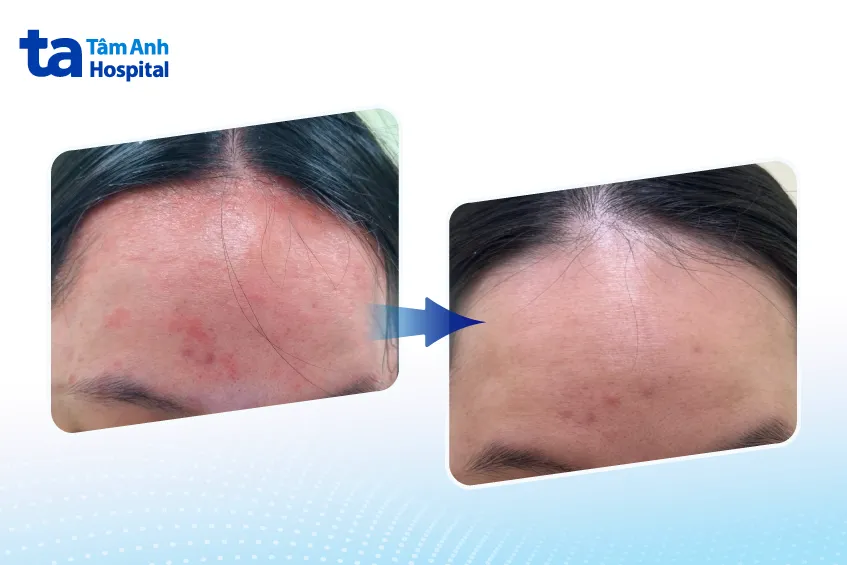 Thuốc sinh học: thêm cánh cửa cho người vảy nến - Ảnh 1.