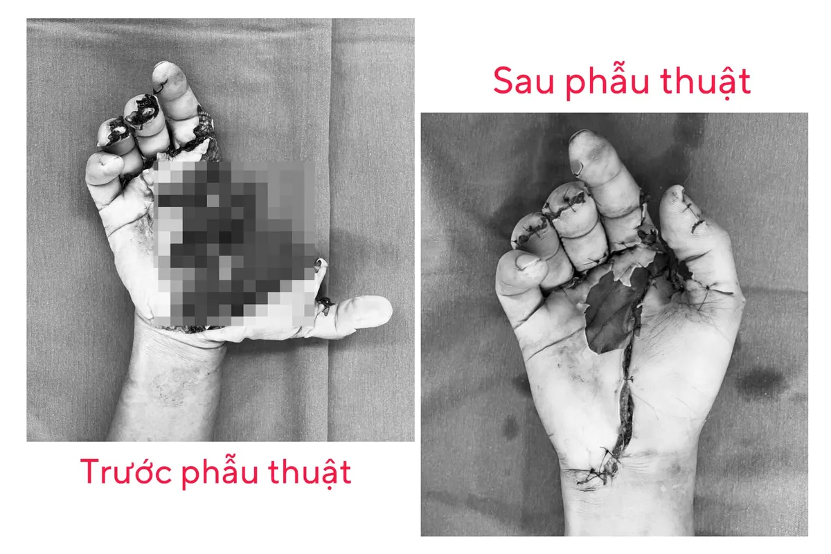 Một bệnh viện ở Hà Nội tiếp nhận 15 ca tai nạn pháo nổ trong 1 ngày - Ảnh 1.