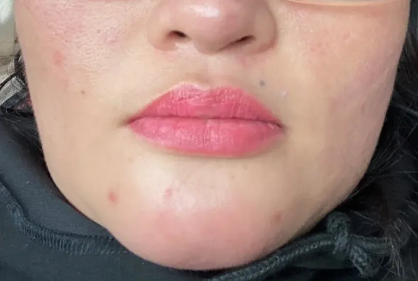 Nhiễm trùng sau khi tiêm filler: Lời cảnh tỉnh cho việc làm đẹp tại cơ sở không uy tín - Ảnh 1. Nhiễm trùng sau khi tiêm filler: Lời cảnh tỉnh cho việc làm đẹp tại cơ sở không uy tín - Ảnh 1.