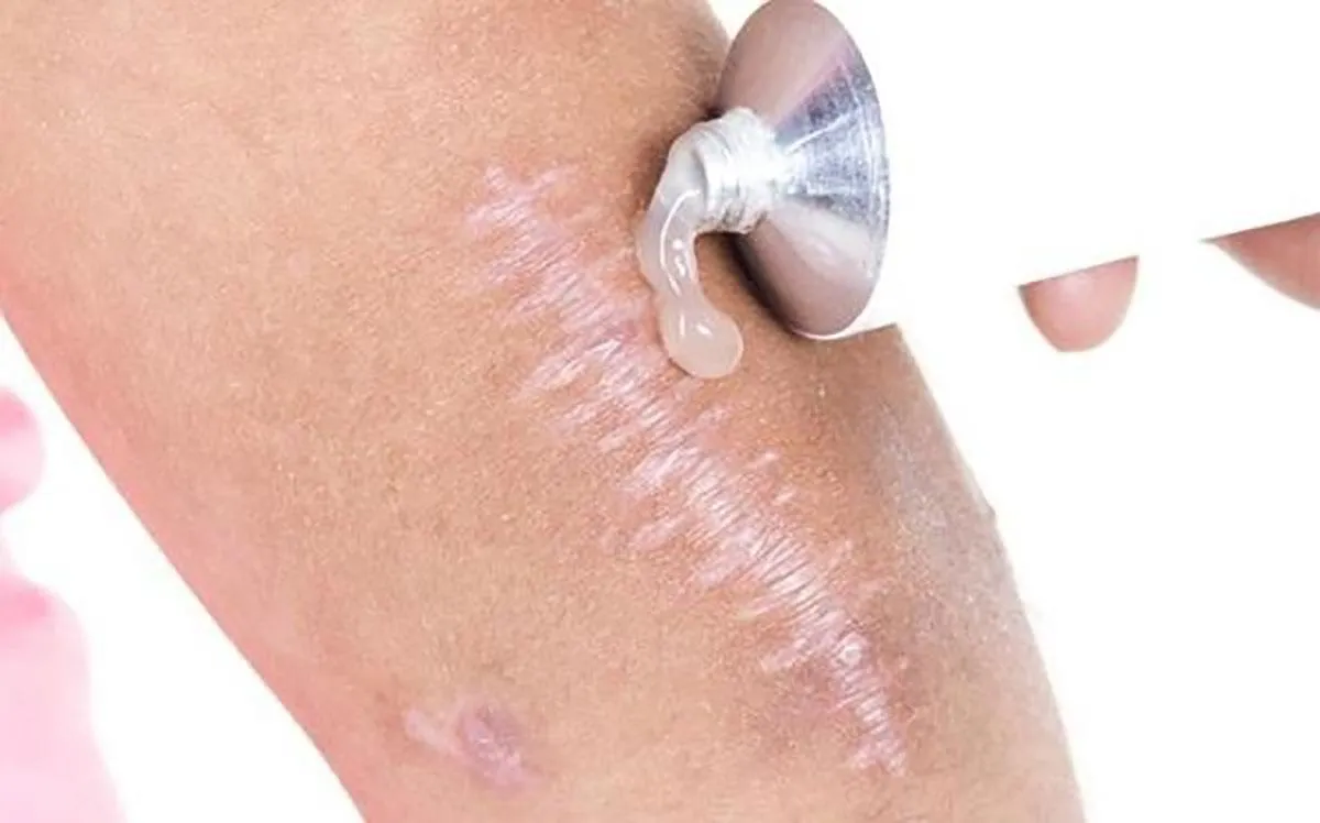 Cùng Actiscar điểm danh những sai lầm nghiêm trọng thường mắc khi xử lý sẹo thâm - Ảnh 2.
