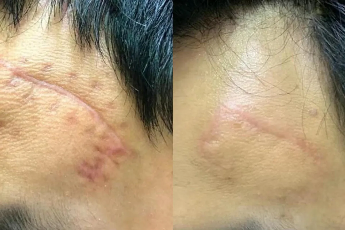 Cùng Actiscar điểm danh những sai lầm nghiêm trọng thường mắc khi xử lý sẹo thâm - Ảnh 5.