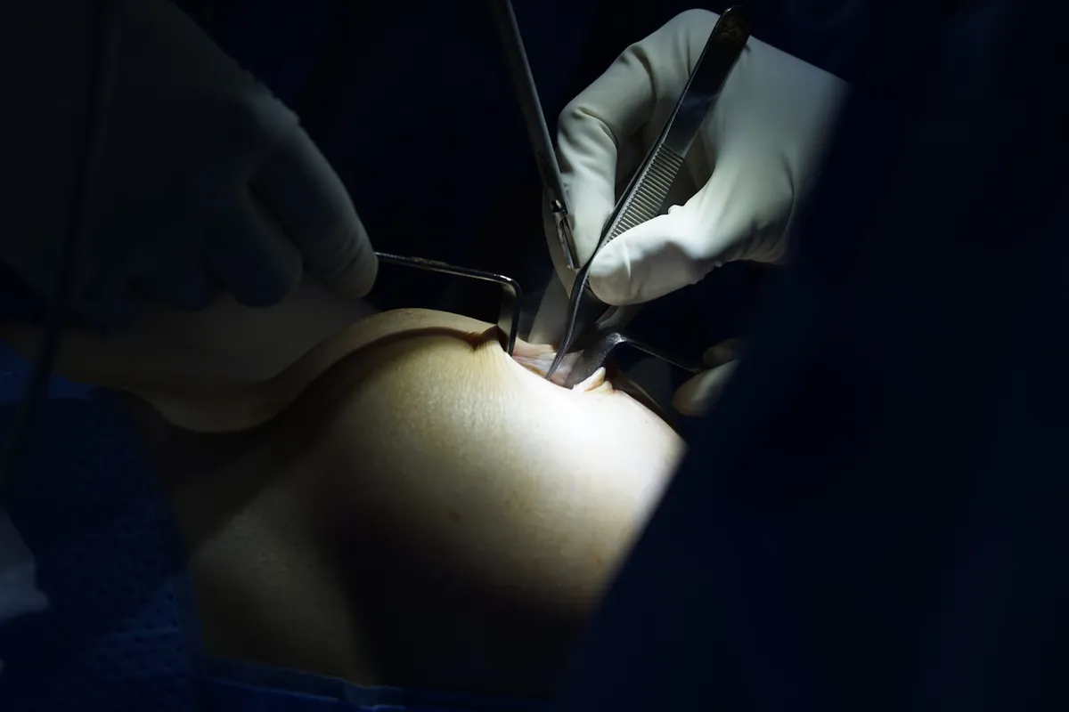 Sự mềm mại của v&ograve;ng 1 sau n&acirc;ng ngực phụ thuộc v&agrave;o c&aacute;c yếu tố n&agrave;o? - Ảnh 5.