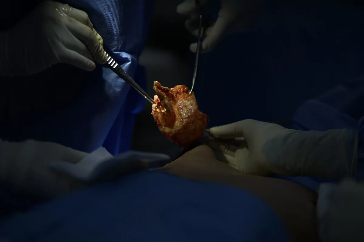 Sự mềm mại của v&ograve;ng 1 sau n&acirc;ng ngực phụ thuộc v&agrave;o c&aacute;c yếu tố n&agrave;o? - Ảnh 4.