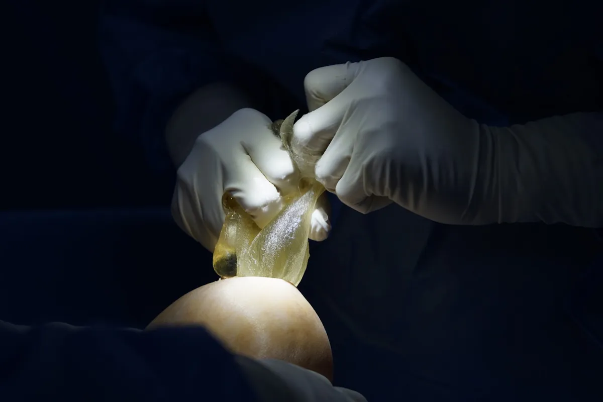 Sự mềm mại của v&ograve;ng 1 sau n&acirc;ng ngực phụ thuộc v&agrave;o c&aacute;c yếu tố n&agrave;o? - Ảnh 2.