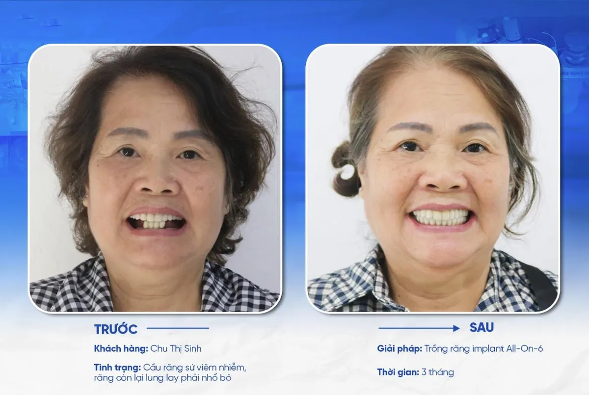 Tại sao công nghệ USI giúp đặt implant An toàn, không sưng, không đau, không chảy máu? - Ảnh 3. Tại sao công nghệ USI giúp đặt implant An toàn, không sưng, không đau, không chảy máu? - Ảnh 3.