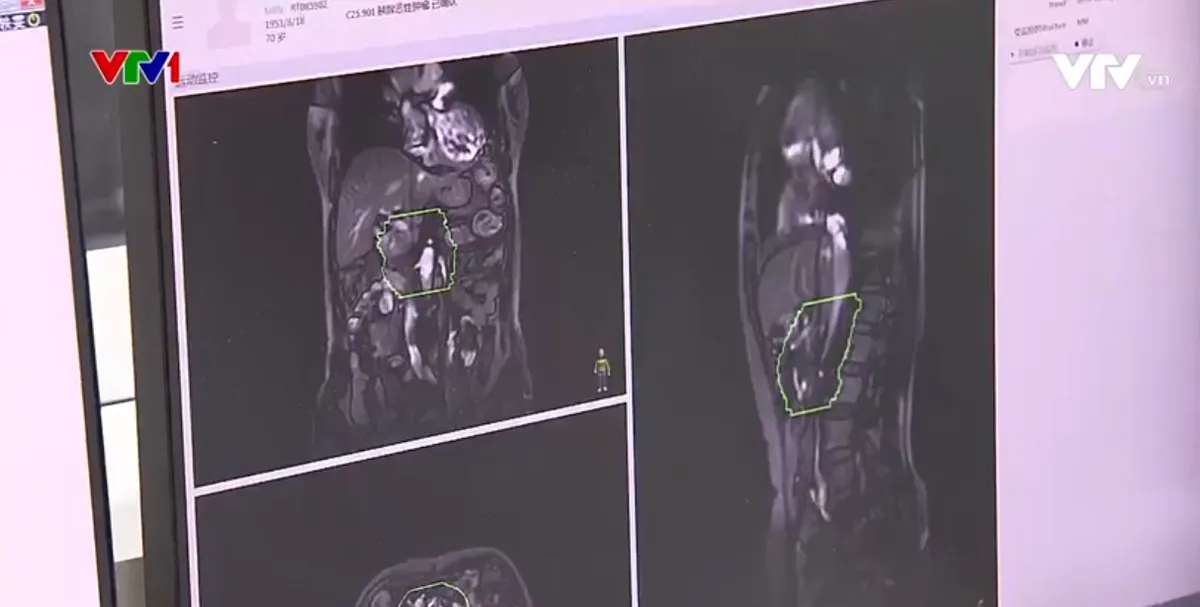 Trung Quốc đưa v&agrave;o sử dụng m&aacute;y xạ trị cộng hưởng từ đầu ti&ecirc;n - Ảnh 1.