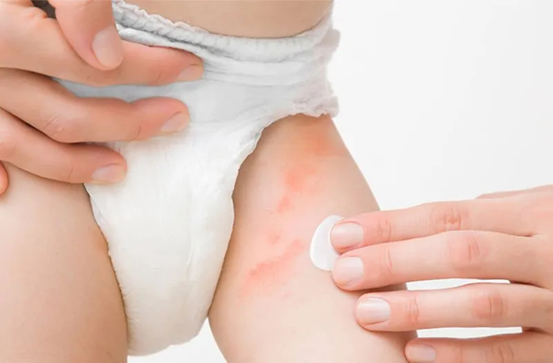 Bỉm Nhật chống hăm to&agrave;n diện Manuka - Ảnh 1.