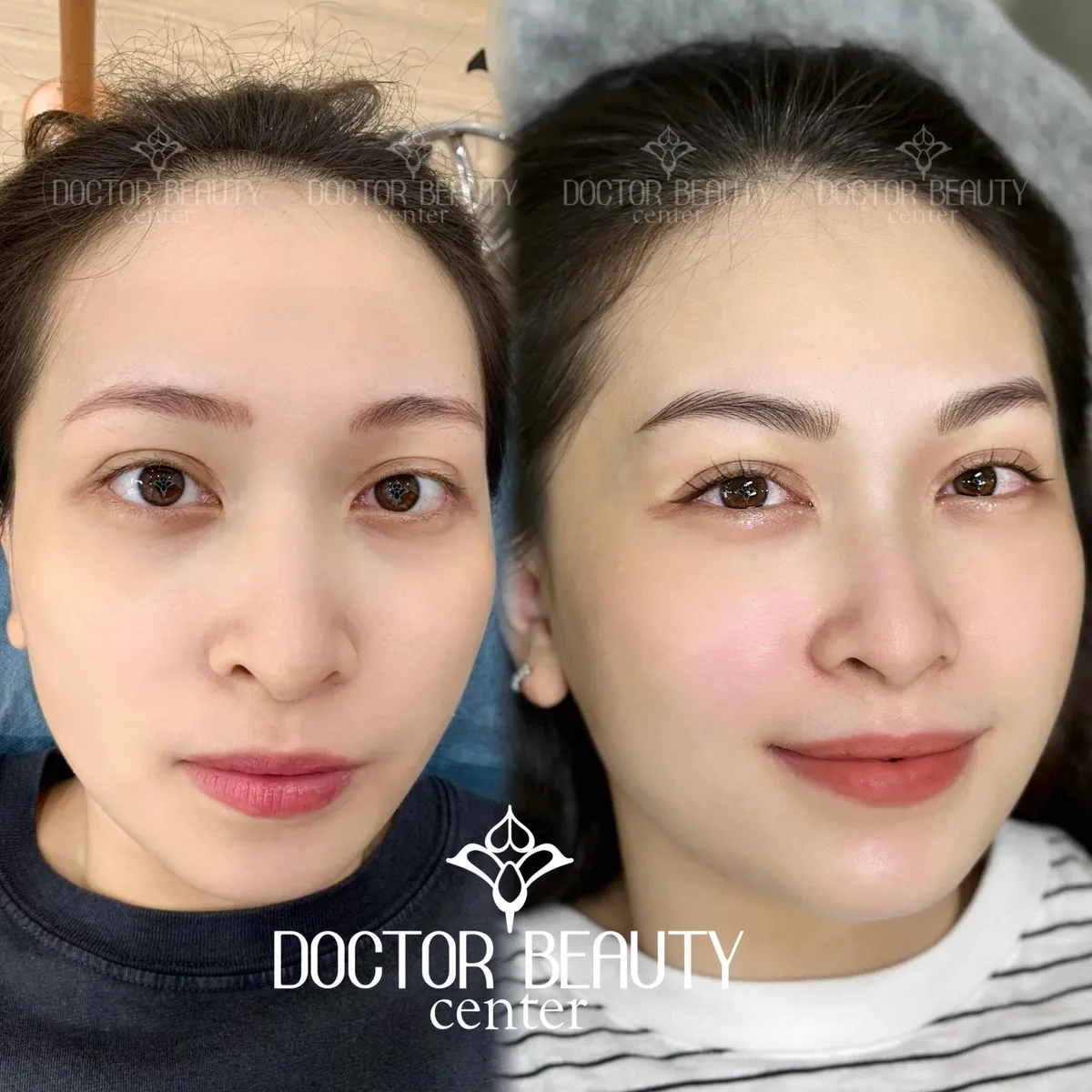 Viện thẩm mỹ Doctor Beauty tặng gói xóa xăm chân mày 8 triệu - Ảnh 1. Viện thẩm mỹ Doctor Beauty tặng gói xóa xăm chân mày 8 triệu - Ảnh 1.