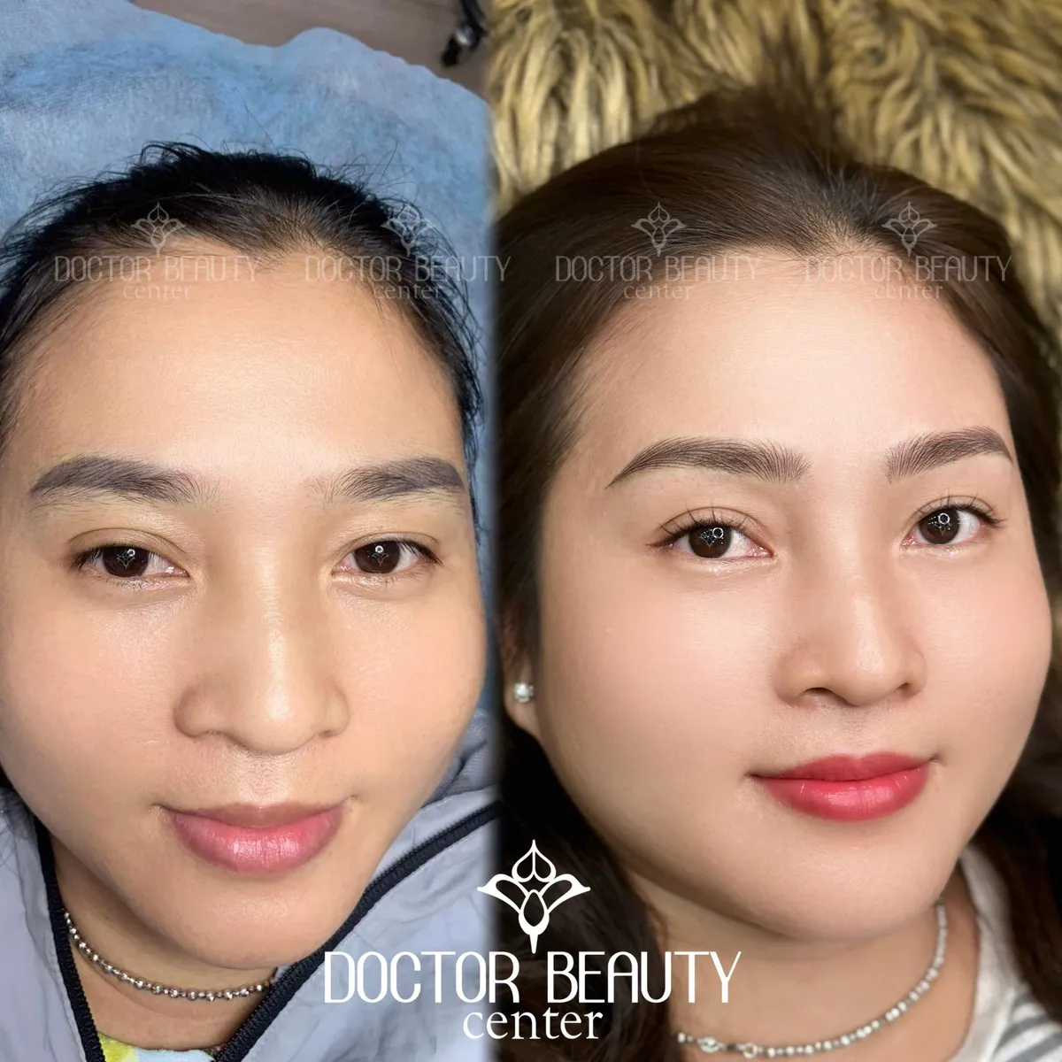 Viện thẩm mỹ Doctor Beauty tặng gói xóa xăm chân mày 8 triệu - Ảnh 2. Viện thẩm mỹ Doctor Beauty tặng gói xóa xăm chân mày 8 triệu - Ảnh 2.