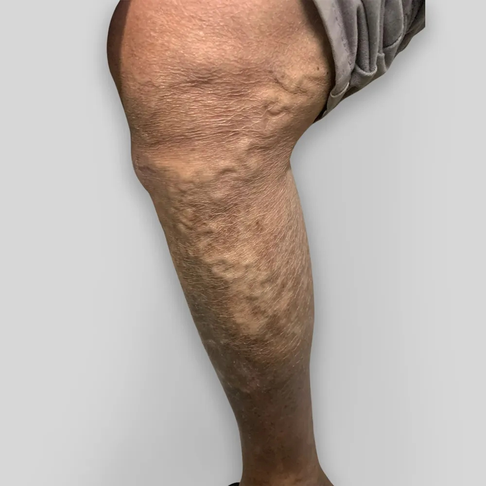 Suy gi&atilde;n tĩnh mạch cần điều trị sớm - Ảnh 4.