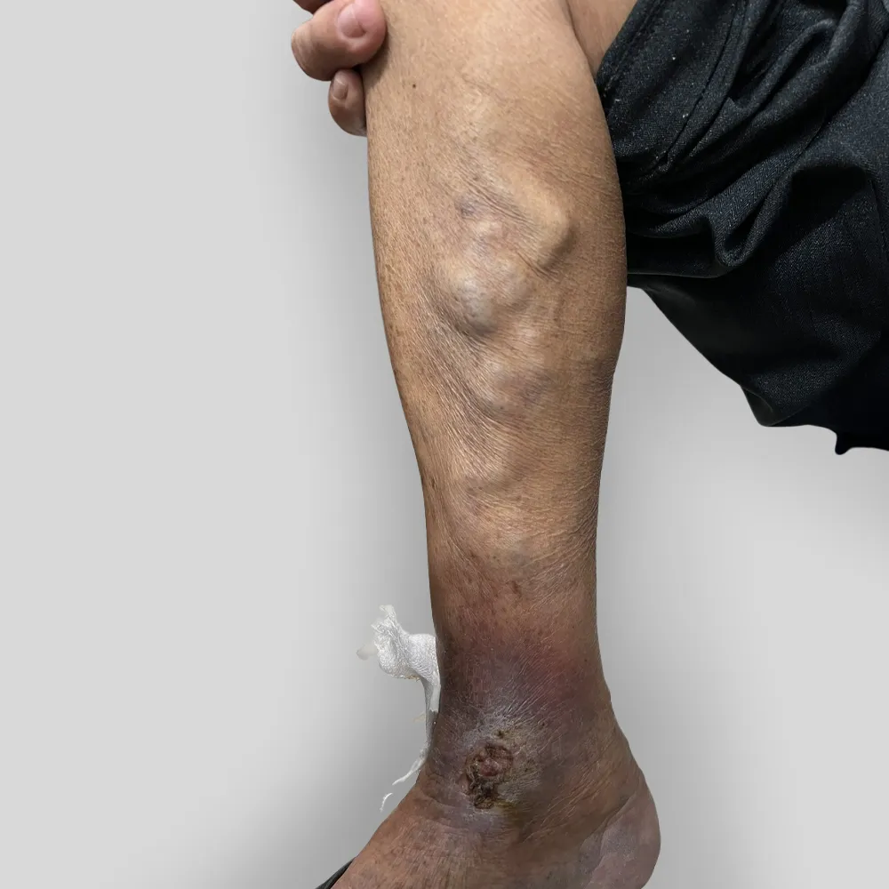 Suy gi&atilde;n tĩnh mạch cần điều trị sớm - Ảnh 3.