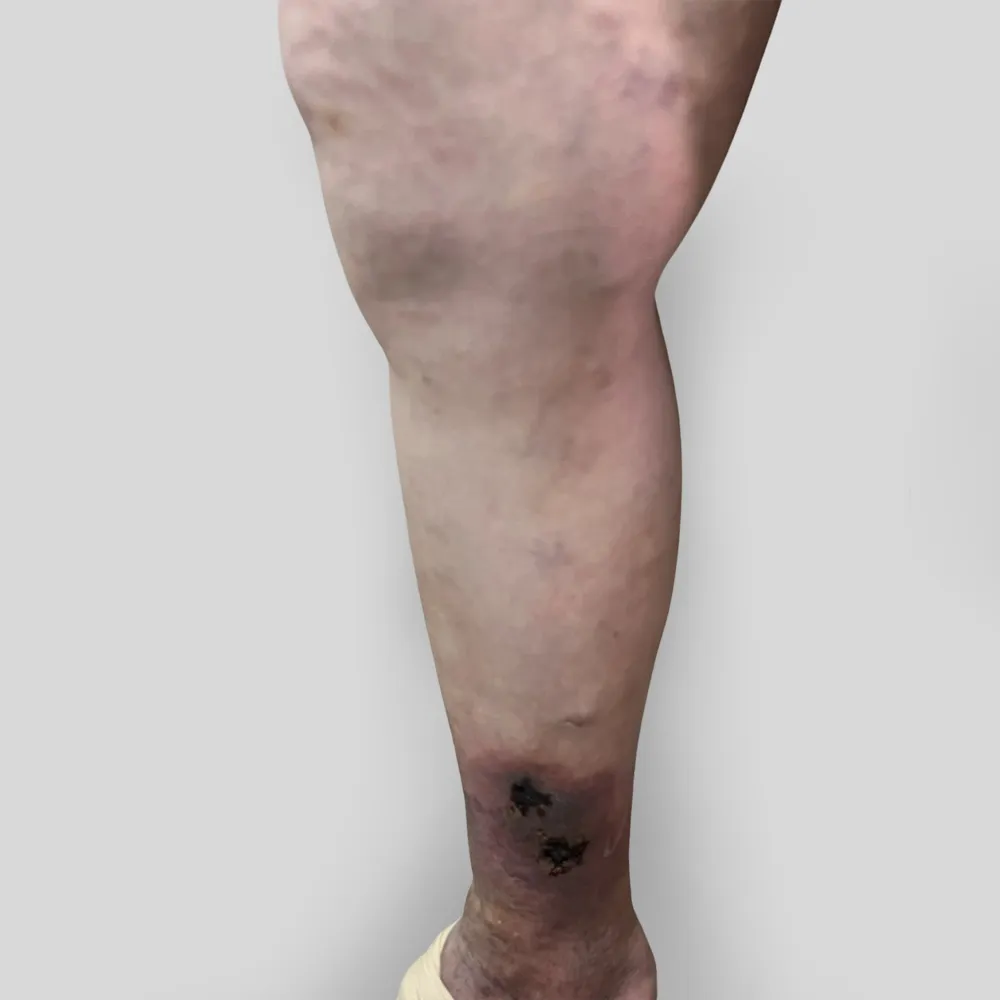 Suy gi&atilde;n tĩnh mạch cần điều trị sớm - Ảnh 2.