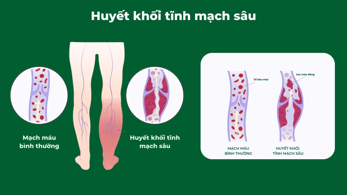 Những bước tiến mới trong việc điều trị suy giãn tĩnh mạch hiện nay - Ảnh 5.