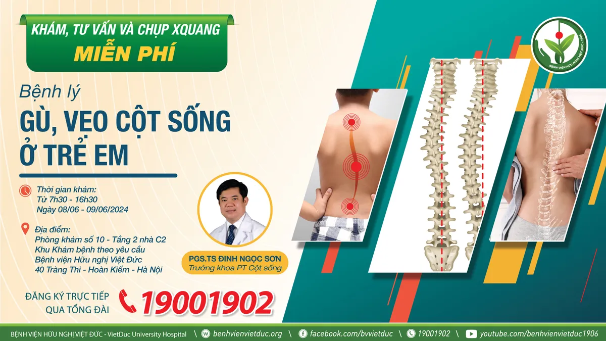 Khám sàng lọc, tư vấn miễn phí gù vẹo cột sống ở trẻ em - Ảnh 1. Khám sàng lọc, tư vấn miễn phí gù vẹo cột sống ở trẻ em - Ảnh 1.