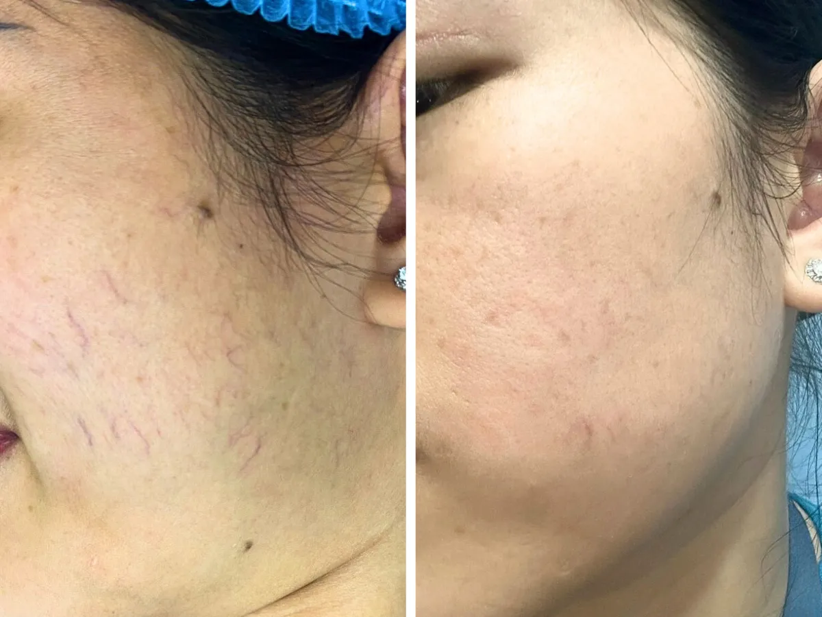 Sclaser khác gì với tiêm xơ trong điều trị giãn tĩnh mạch? - Ảnh 3. Sclaser khác gì với tiêm xơ trong điều trị giãn tĩnh mạch? - Ảnh 3.