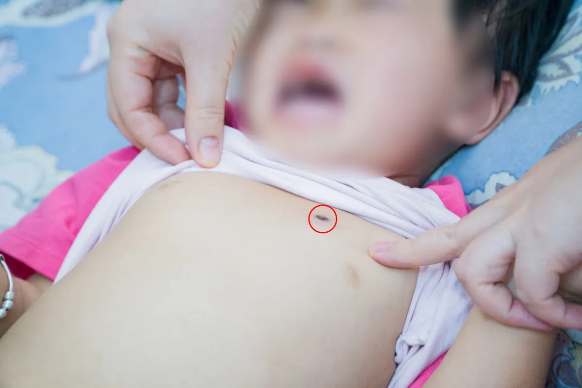 Bệnh sốt mò: Khó phát hiện, không chú ý có thể dẫn đến tử vong - Ảnh 1.
