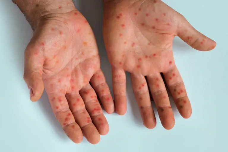 WHO họp khẩn về sự lây lan của bệnh đậu mùa khỉ - Ảnh 1.