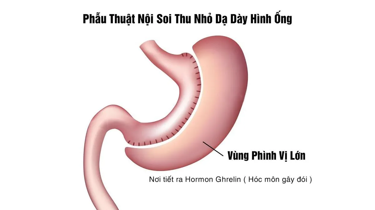 Điều trị b&eacute;o ph&igrave; bằng phẫu thuật nội soi thu nhỏ dạ d&agrave;y h&igrave;nh ống - Ảnh 1.