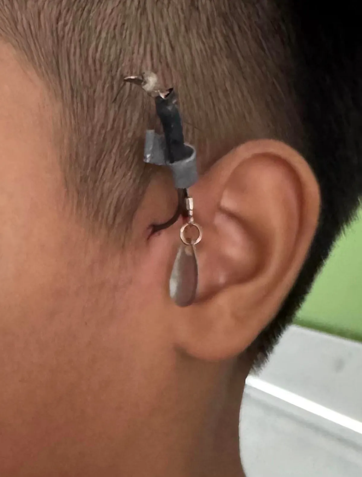 Lấy móc câu cá đâm sâu vào vùng tai bé trai - Ảnh 1. Lấy móc câu cá đâm sâu vào vùng tai bé trai - Ảnh 1.