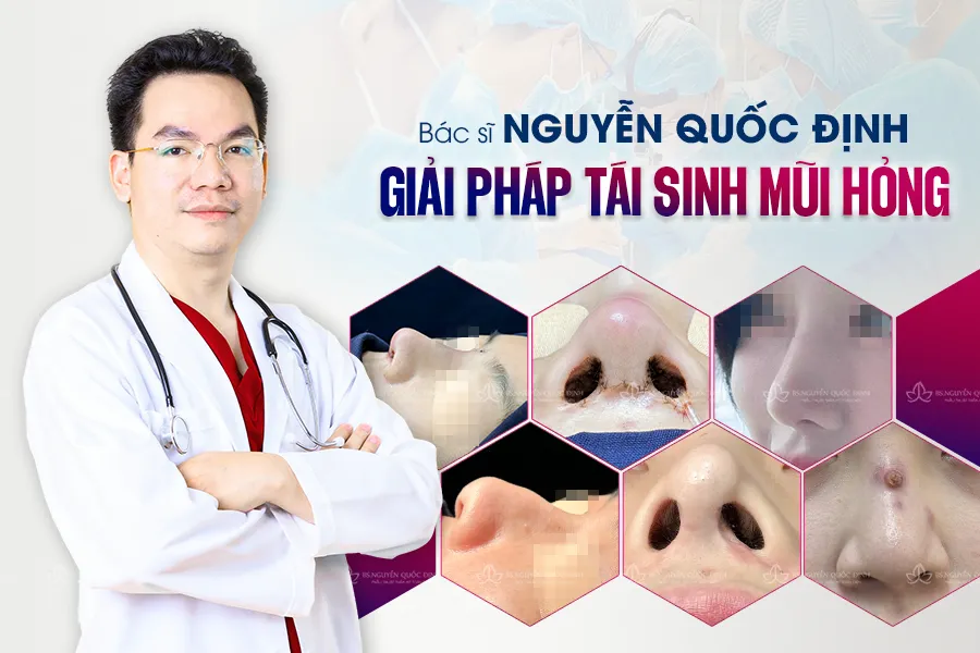 Bị hỏng mũi sau phẫu thuật thẩm mỹ, chị em cần làm gì? - Ảnh 1. Bị hỏng mũi sau phẫu thuật thẩm mỹ, chị em cần làm gì? - Ảnh 1.