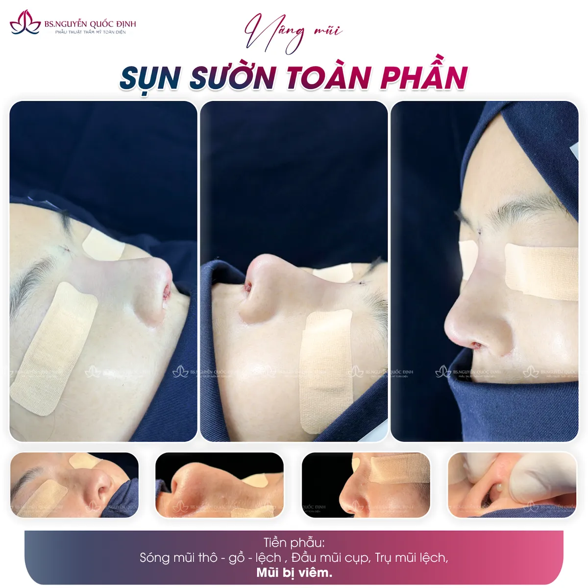 Bị hỏng mũi sau phẫu thuật thẩm mỹ, chị em cần làm gì? - Ảnh 2. Bị hỏng mũi sau phẫu thuật thẩm mỹ, chị em cần làm gì? - Ảnh 2.