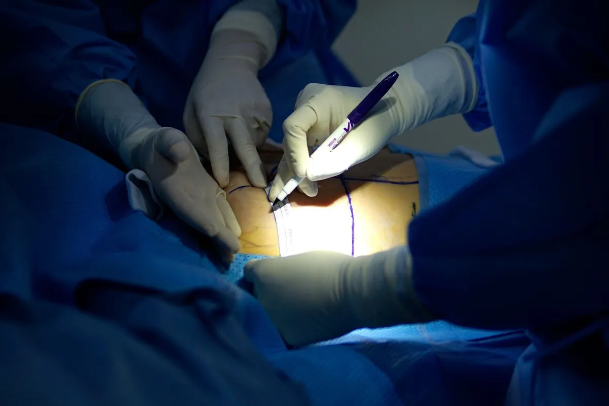 Những lưu ý trước phẫu thuật tháo túi ngực và đặt lại túi mới - Ảnh 2. Những lưu ý trước phẫu thuật tháo túi ngực và đặt lại túi mới - Ảnh 2.