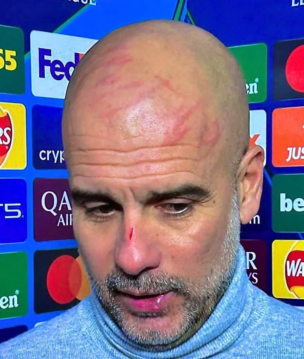 Pep Guardiola tự c&agrave;o xước mặt sau trận h&ograve;a như thua của Man City - Ảnh 1.