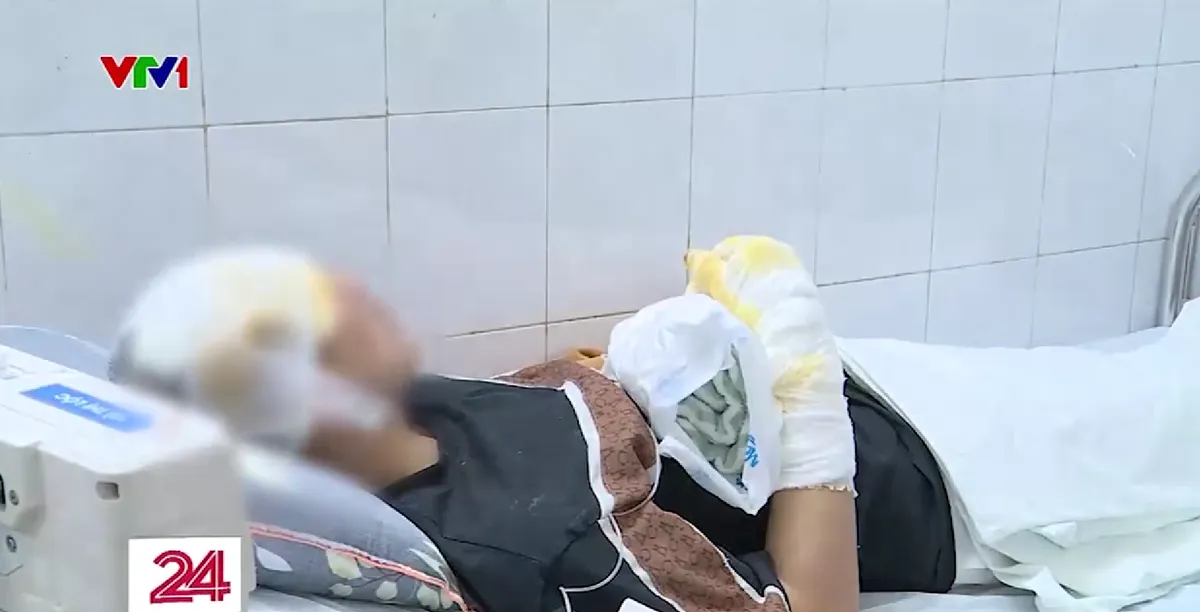 Liên tiếp cấp cứu nhiều bệnh nhân bỏng do tự chế pháo - Ảnh 1.