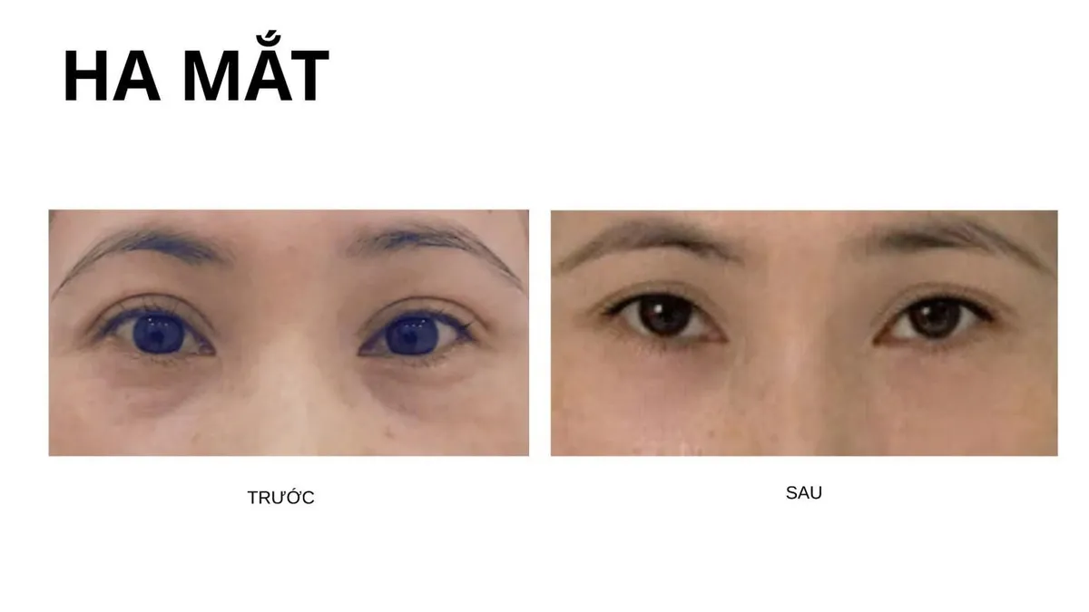 Làm đẹp thông minh cùng chất làm đầy Hyaluronic Axit - Ảnh 4.