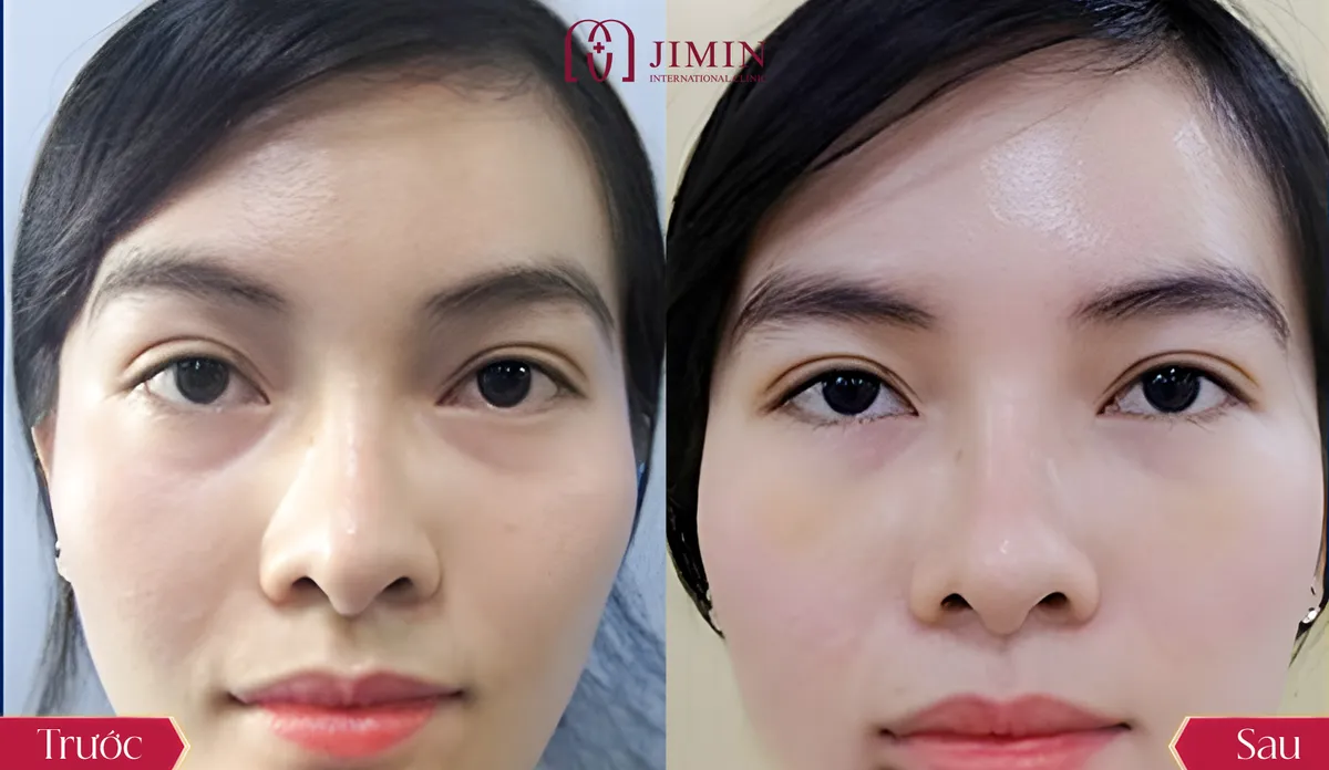 Giải pháp trẻ hóa đôi mắt tại Phòng khám chuyên khoa phẫu thuật thẩm mỹ Jimin - Ảnh 4.