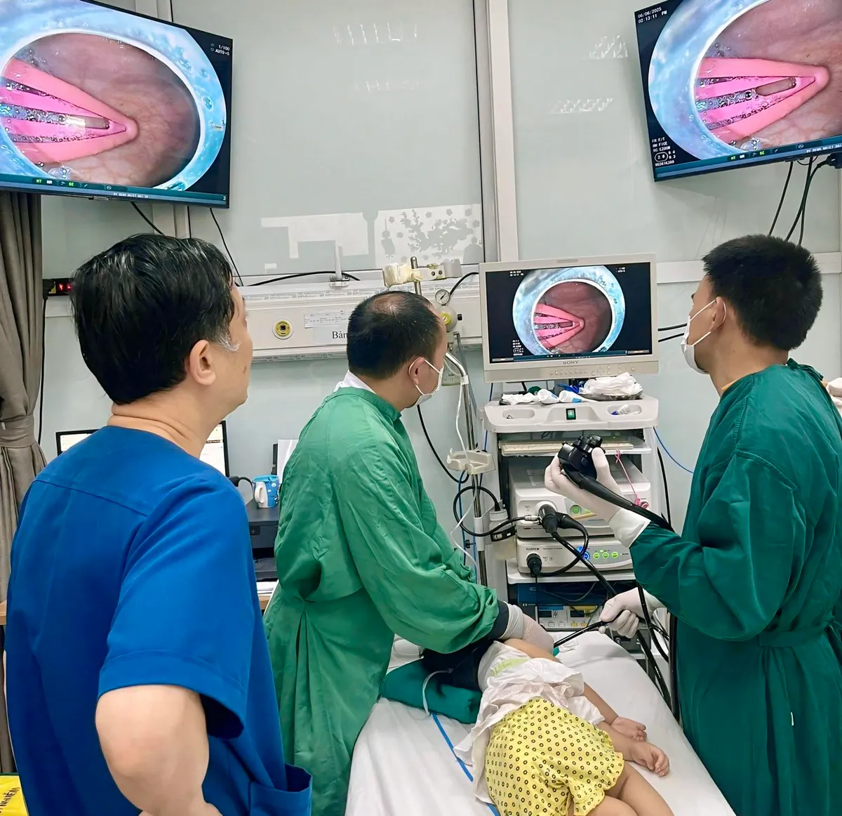 Gắp thành công kẹp tóc dài 5cm trong dạ dày bé gái 21 tháng tuổi - Ảnh 2.